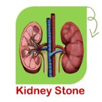 Kidney stone Kidney stone